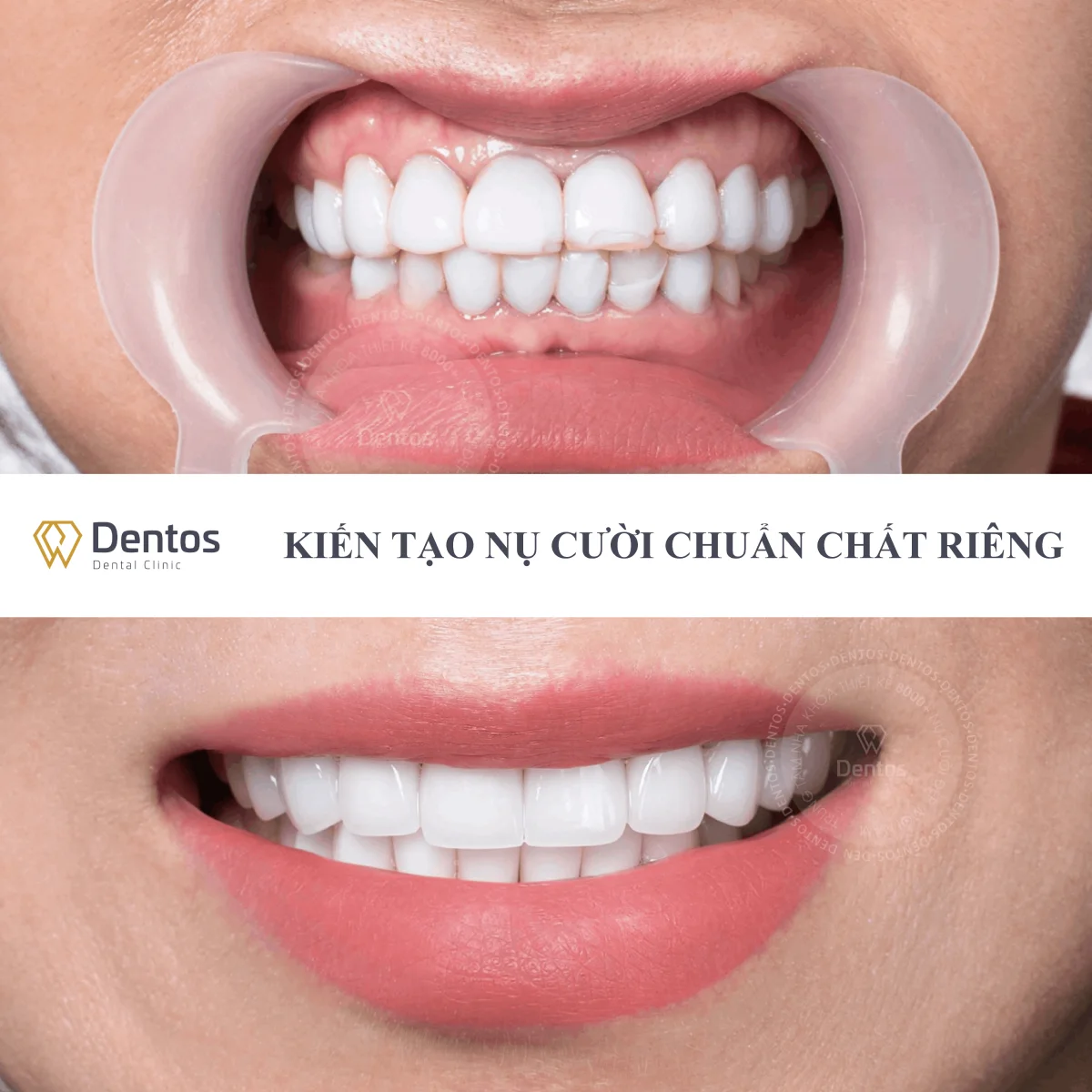 Khắc phục hậu quả phủ sứ nano – Lột xác với bọc răng sứ thẩm mỹ